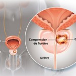 Tout ce qu’il faut savoir sur le cancer de prostate